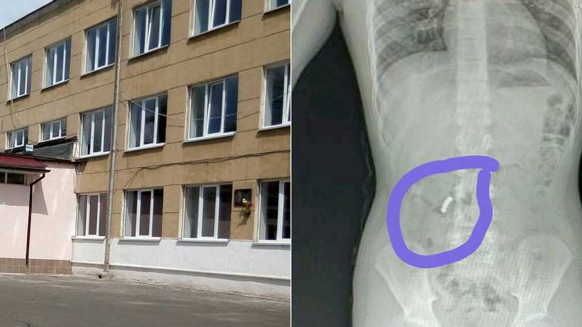 Почали склеювати внутрішні органи: на Одещині учениця у школі проковтнула магніти